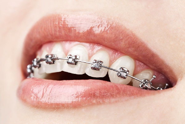 Braces treatment