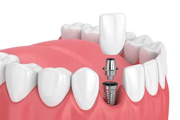 Dental implants