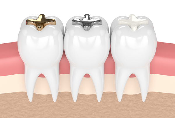 Dental filings